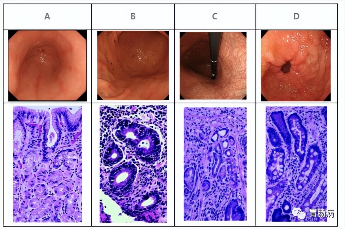 肠化和异型增生是一样吗,肠化严重吗可以手术吗