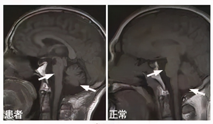 【小帕讲故事】诊断多系统萎缩1、2、3