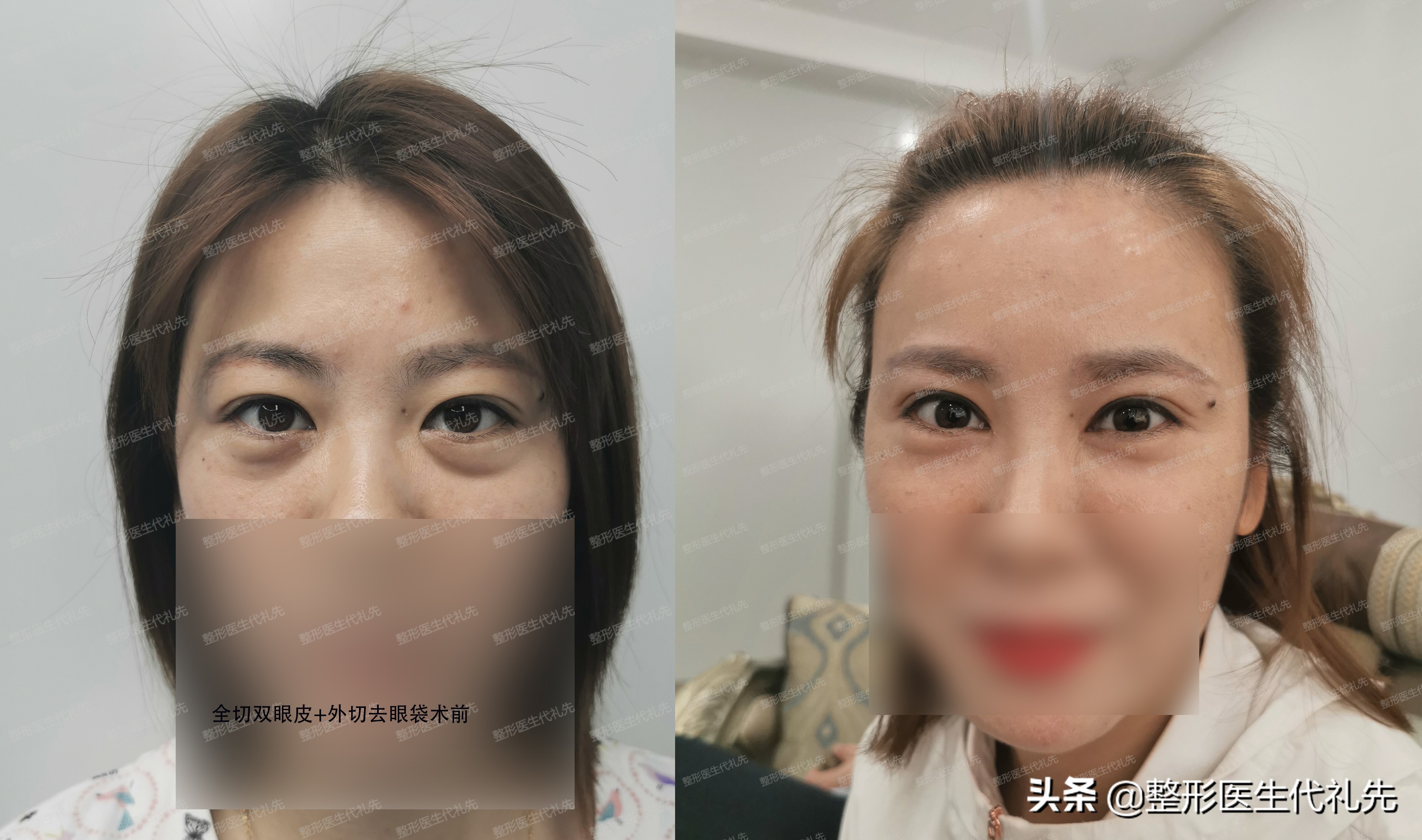 眼轮匝肌肥厚型眼袋的治疗体会,眼轮匝肌肥厚型眼袋怎么外切