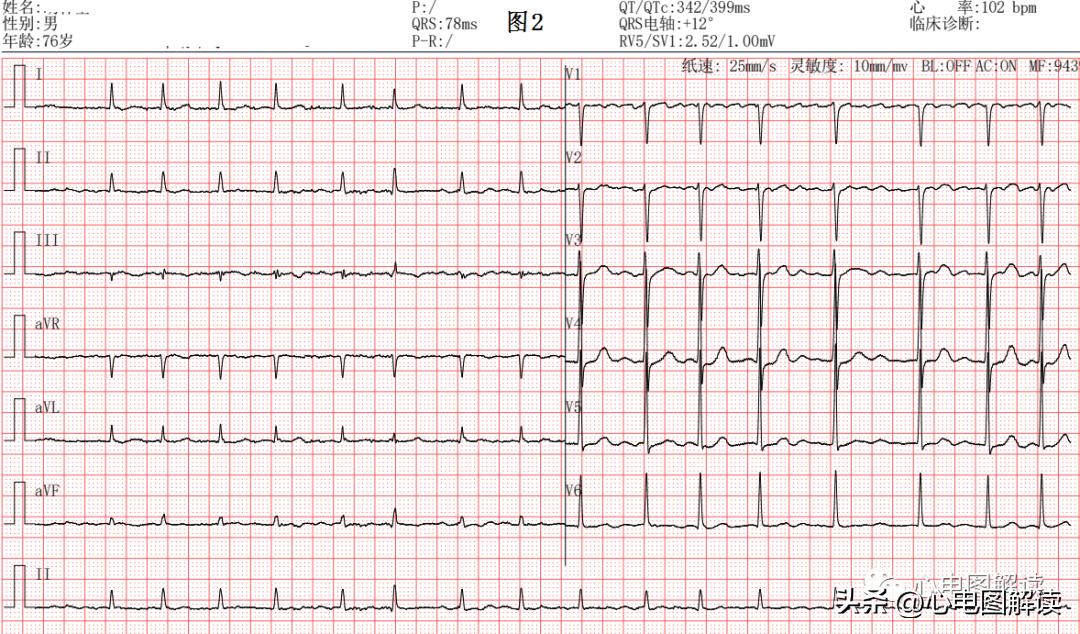 灏忓効蹇冩埧棰ゅ姩,蹇冩埧棰ゅ姩璇句欢