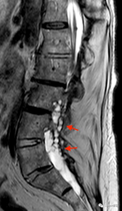 硬膜扩张,duralectasia