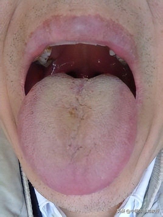 湿热最怕的草药,脾胃湿热和肝胆湿热同治的中成药