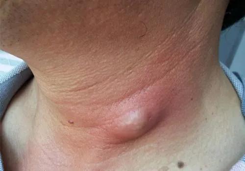 皮肤上的小肉粒是什么东西,皮肤上的肉疙瘩究竟是什么