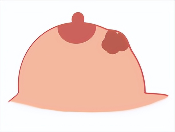 乳房有肿块并且疼痛要做穿刺,为什么医生让做乳腺穿刺