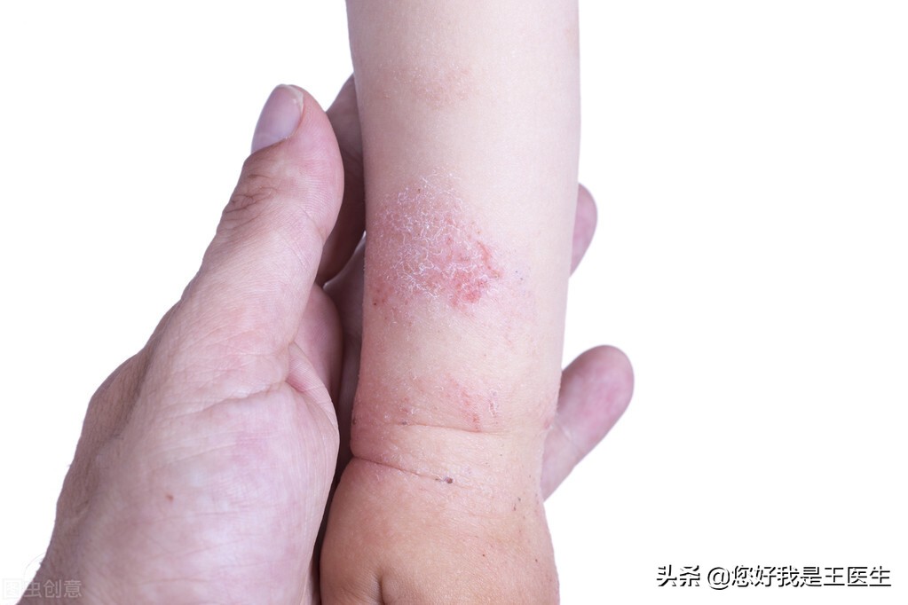 孩子湿疹反复记住这三招,孩子湿疹反复怎么食疗