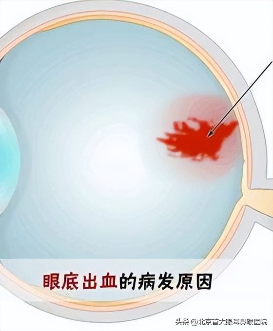 北京同仁医院眼底出血最权威专家,北京看眼底病哪个医院最好
