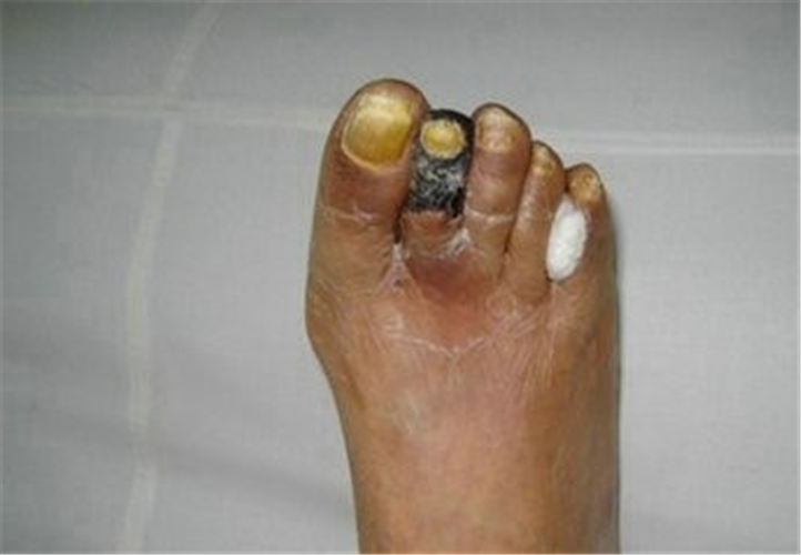 糖尿病足患者怎么让脚不肿胀,糖尿病足小脚趾肿胀怎么治疗