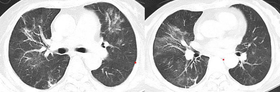 如何解读mNGS阴性结果？何时可能出现假阴性？真阴性又是为何？