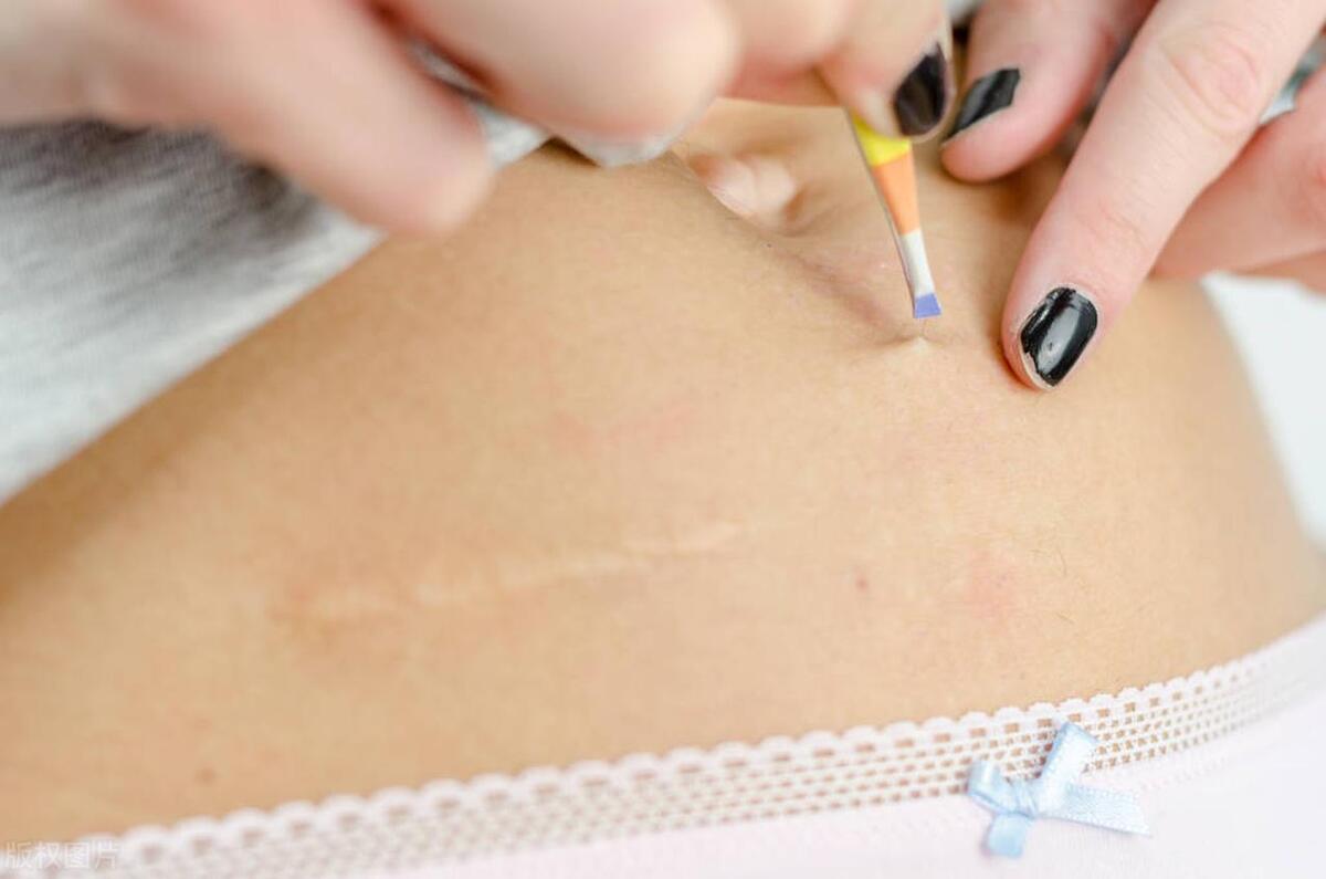 增生性疤痕如何治疗,肥厚性瘢痕怎么治疗有效果