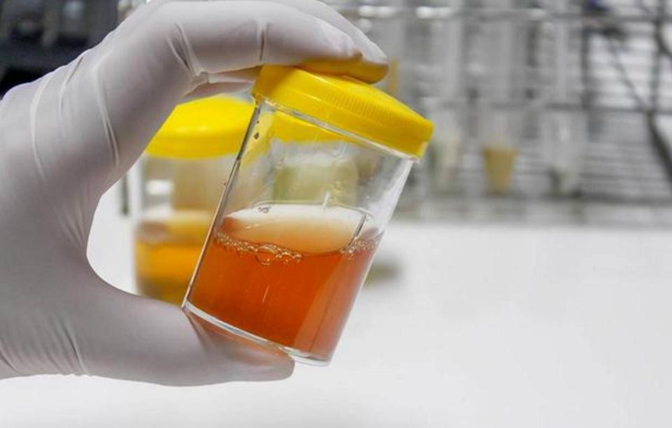 男性尿液有泡沫就是肾出了问题吗,小便有细小泡沫肾没问题怎么回事