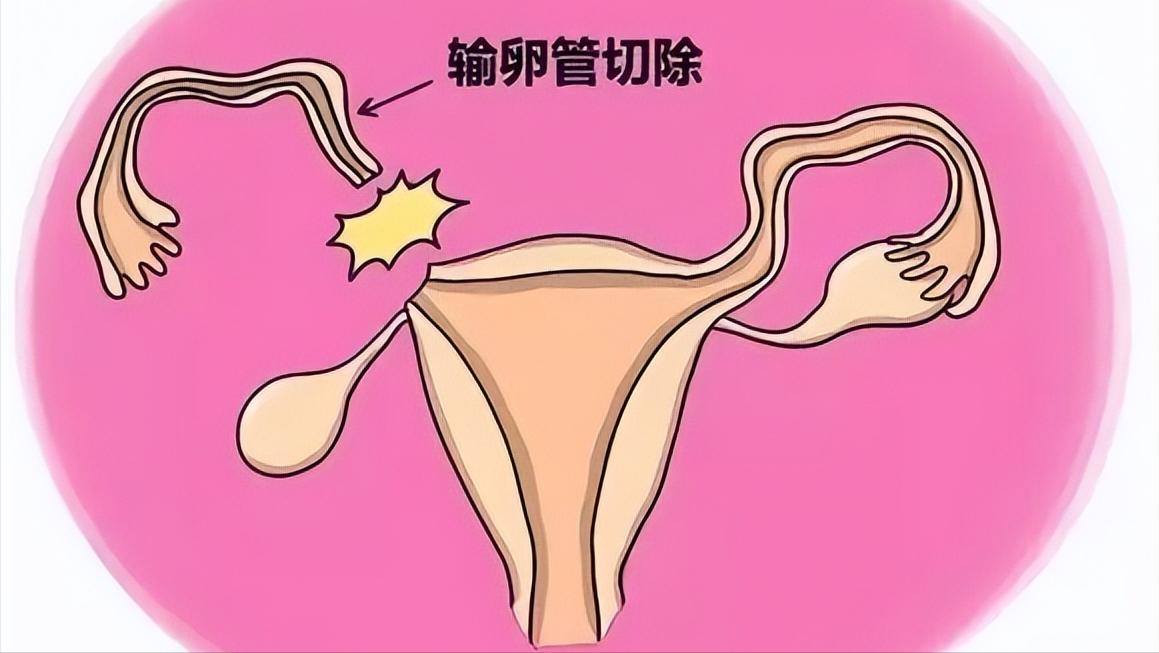 宫外孕都是有什么状况,宫外孕是怎么回事严重吗