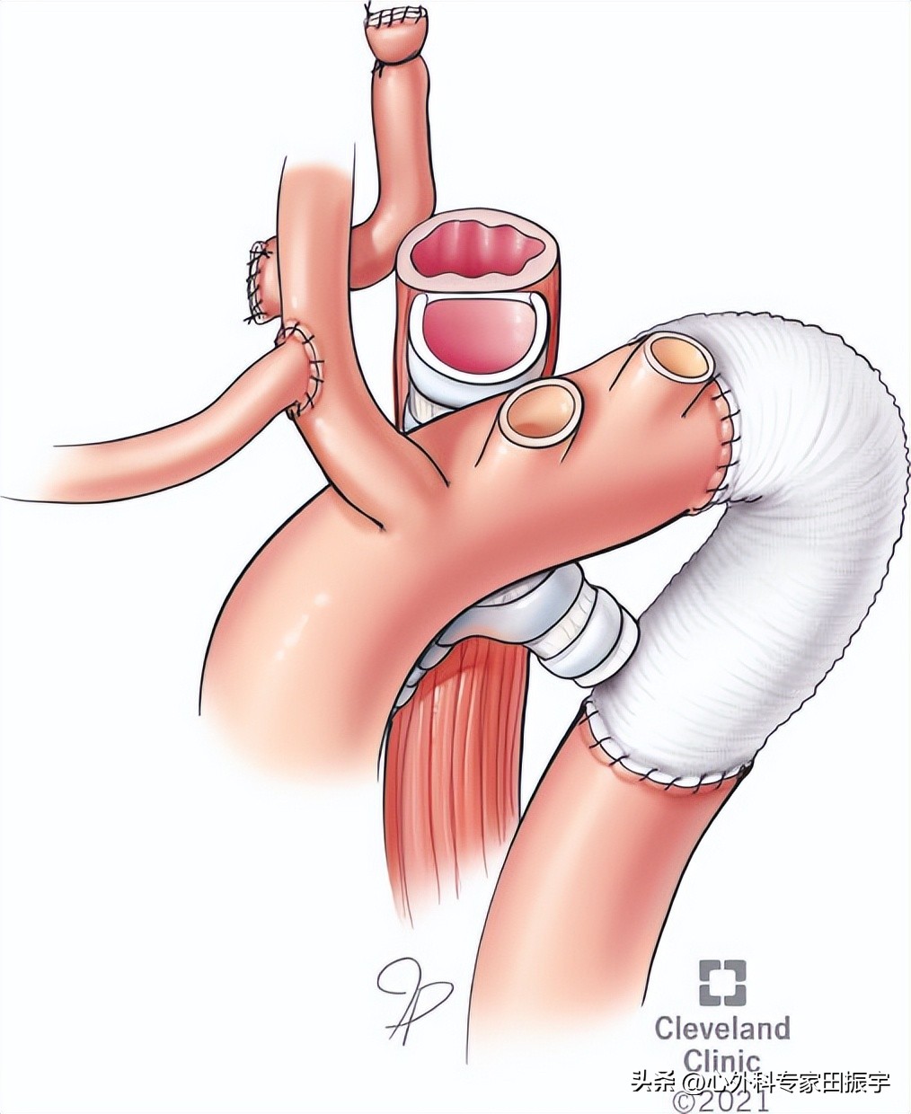 Kommerell憩室和迷走型锁骨下动脉修复术