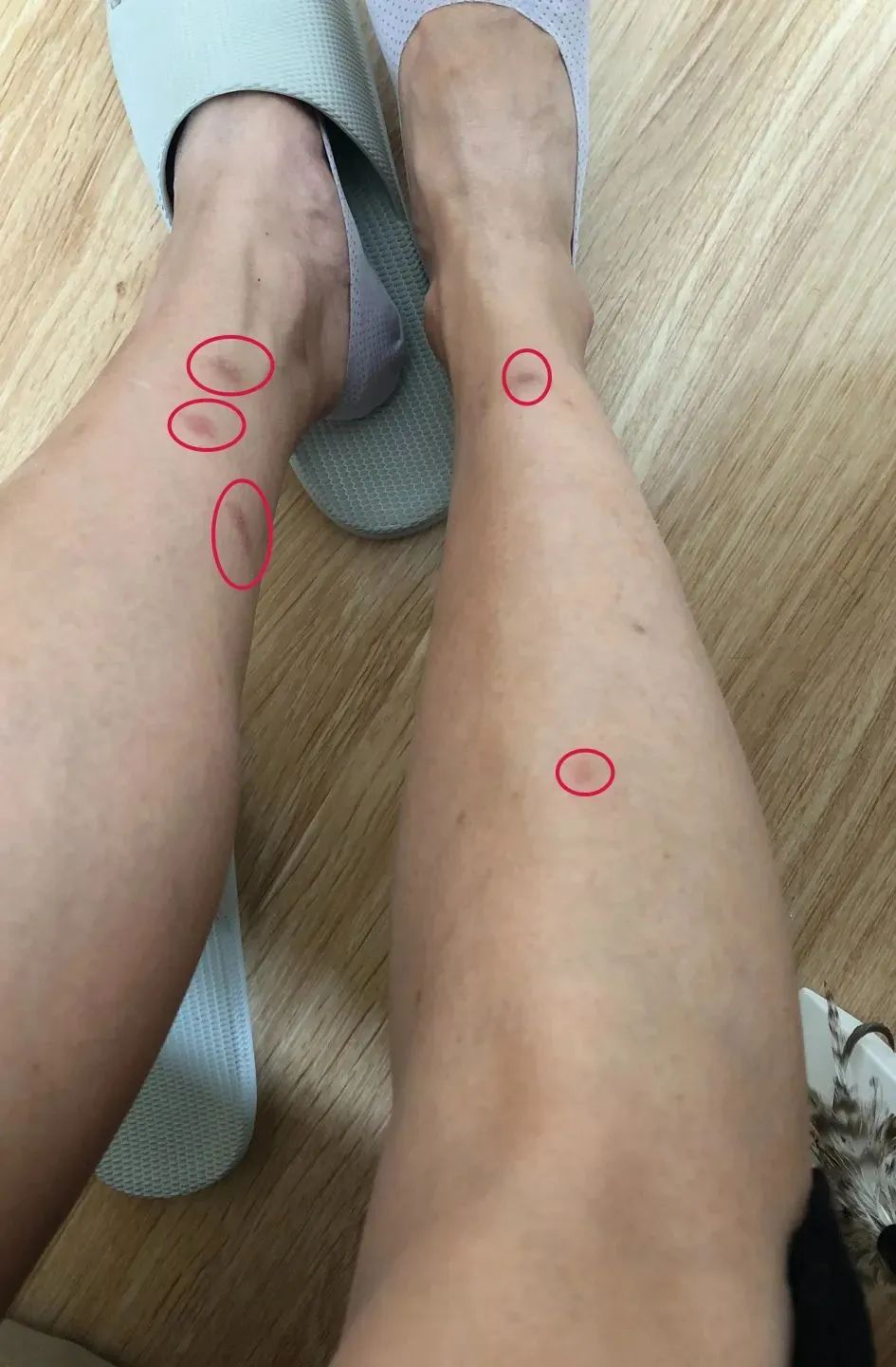 去公园可怕的虫子,去公园如何避免蚊虫叮咬