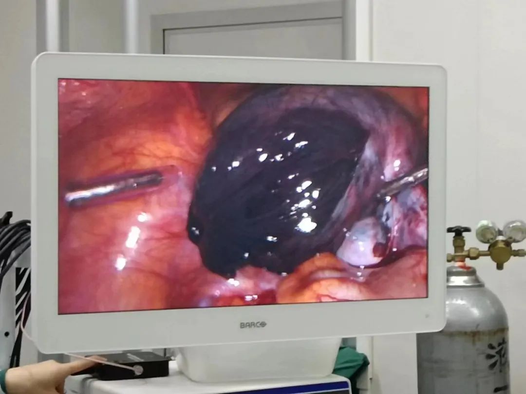 九岁女孩肚子疼是肠子的问题吗,9岁女孩肚子疼痛难忍