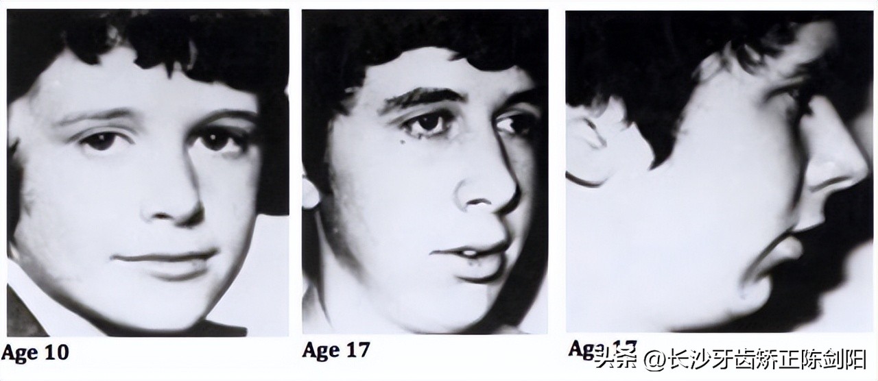 张嘴呼吸怎么自然改善,睡觉张嘴呼吸会变丑的图片