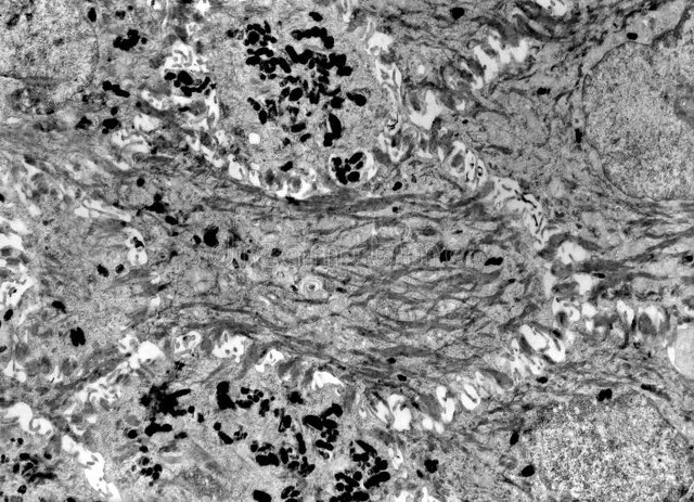 为啥白头发多了,人老了缺乏什么营养素