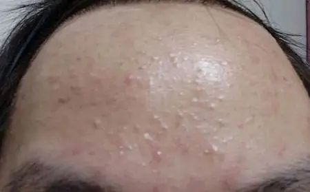 舒善：如何快速区分脸上的白色小疙瘩？