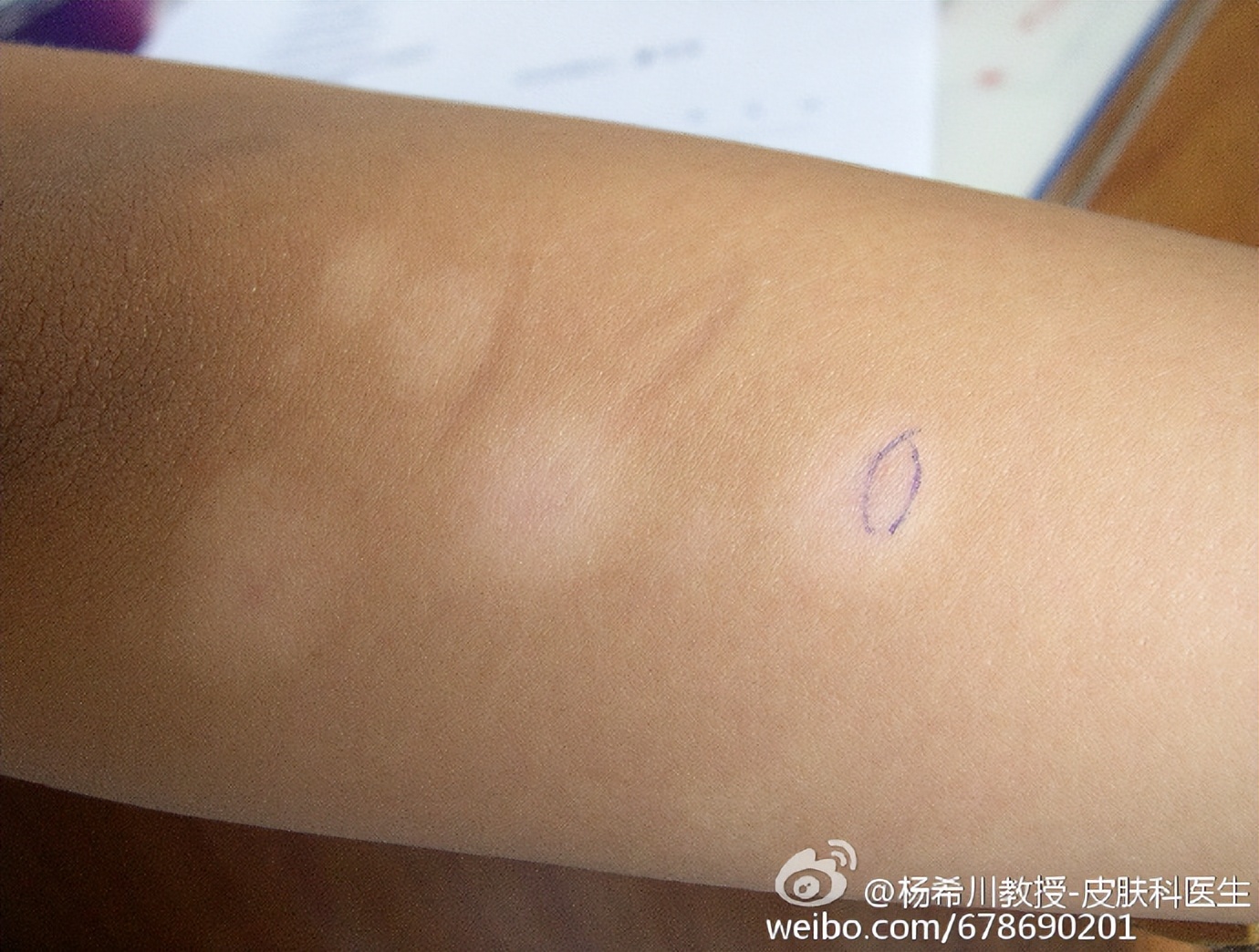 有什么白斑是不用治疗的,白斑怎样治疗才能消失呢