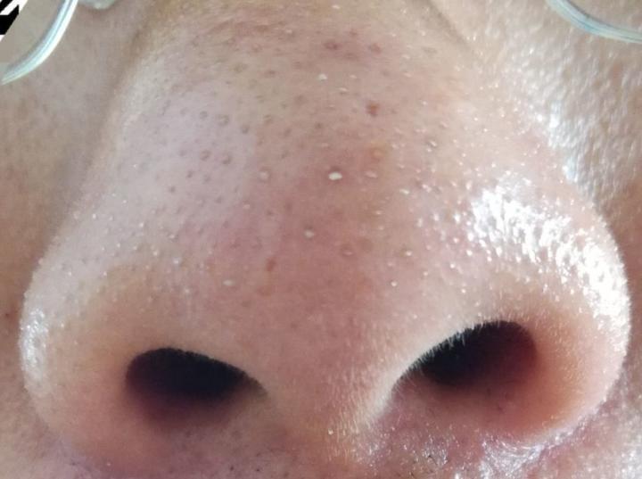 黑头没有弄出来就封口了怎么办,贴黑头贴导致毛孔变大怎么办