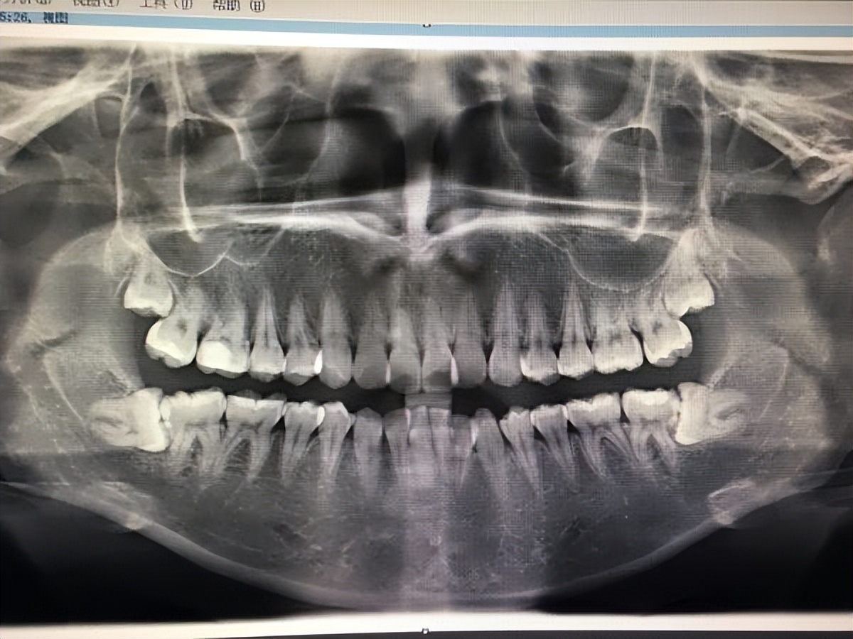 怎么判断长智齿还是牙龈肿痛,怎么判断是牙龈肿痛还是长智齿