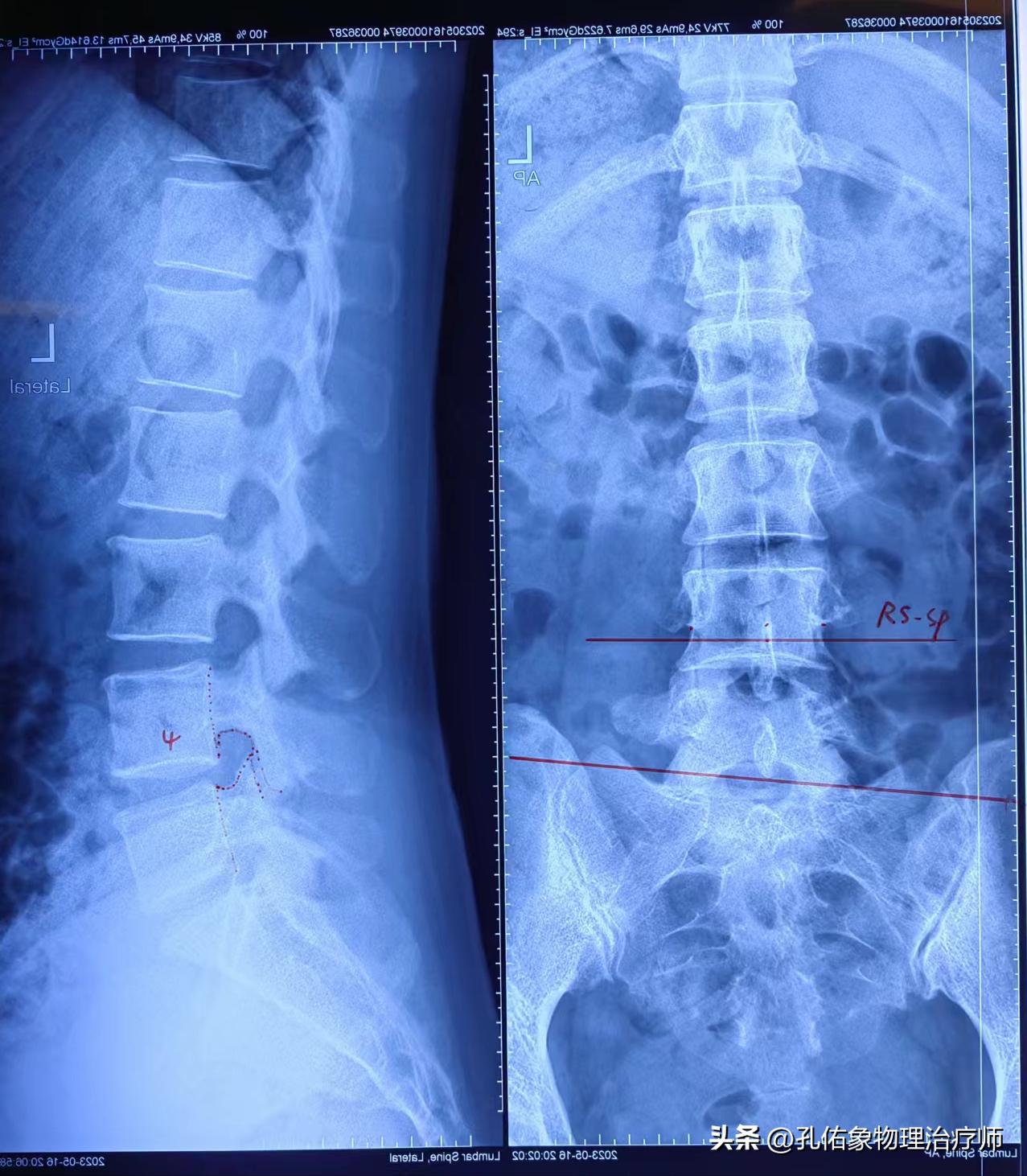 从臀部到小腿麻木疼痛怎么回事,臀部小腿酸胀是怎么回事