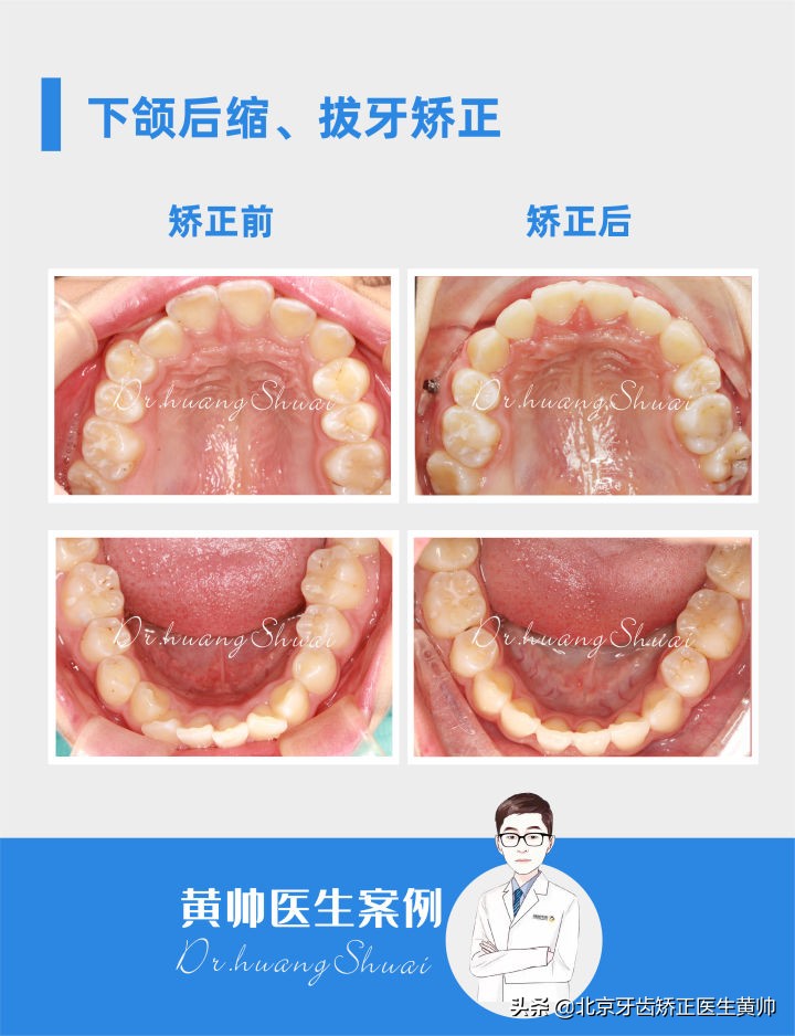 嘴凸的人怎么笑起来好看,嘴型比较凸的人怎么改善