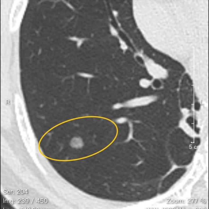 11mm混合磨玻璃结节是浸润癌概率,7mm的混合磨玻璃结节容易转癌吗