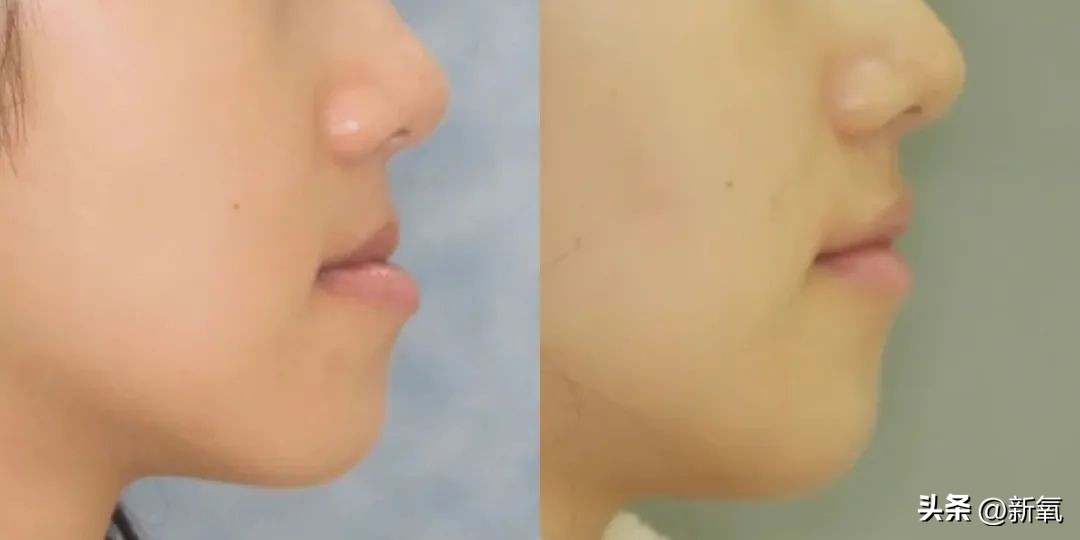 牙齿正畸和骨骼正畸的区别,牙齿正畸和眼轴增长有关系吗