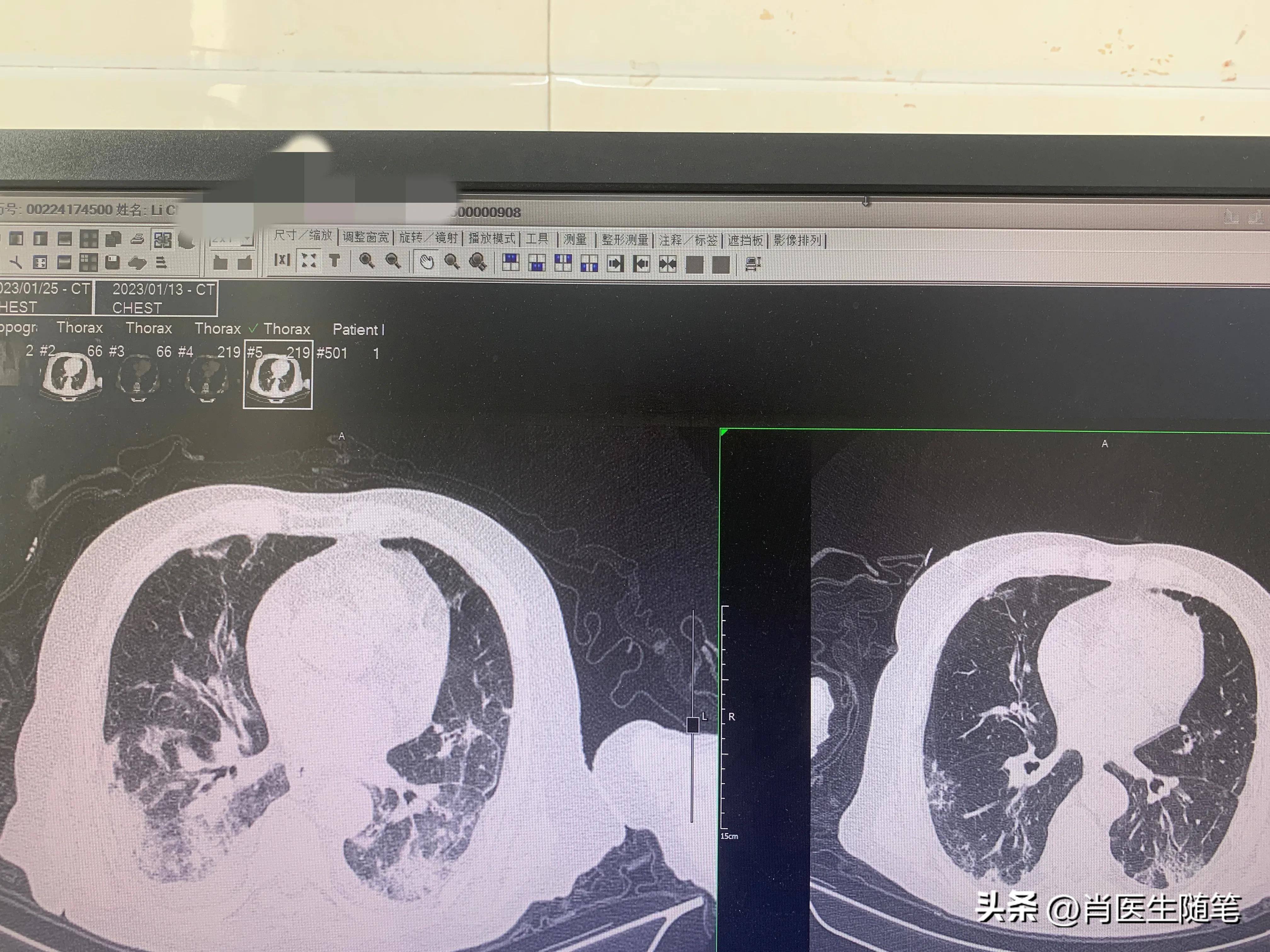 84岁老人白肺治好了,86岁老人得了大白肺还有救吗