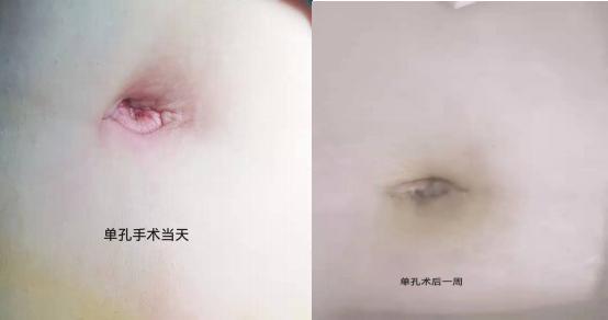 肚脐微创伤口没结疤直接愈合,腹部不留疤的手术