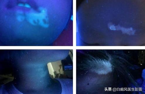伍德灯下面的白斑是什么,伍德灯下各种颜色的白斑代表什么