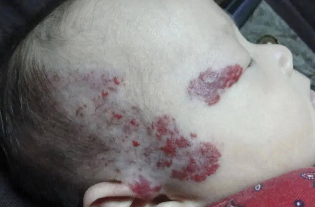 婴幼儿血管瘤有哪几种类型,婴幼儿血管瘤治疗后会留疤吗