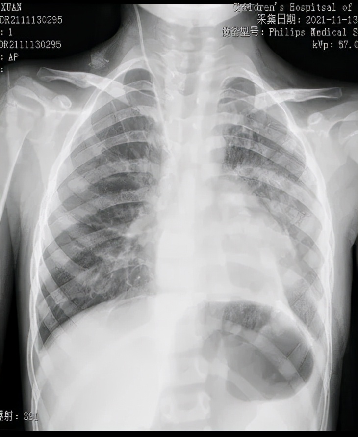 5岁儿童胃炎还胀气咕噜响怎么办,四岁孩子偶尔说胃和食管交界处疼