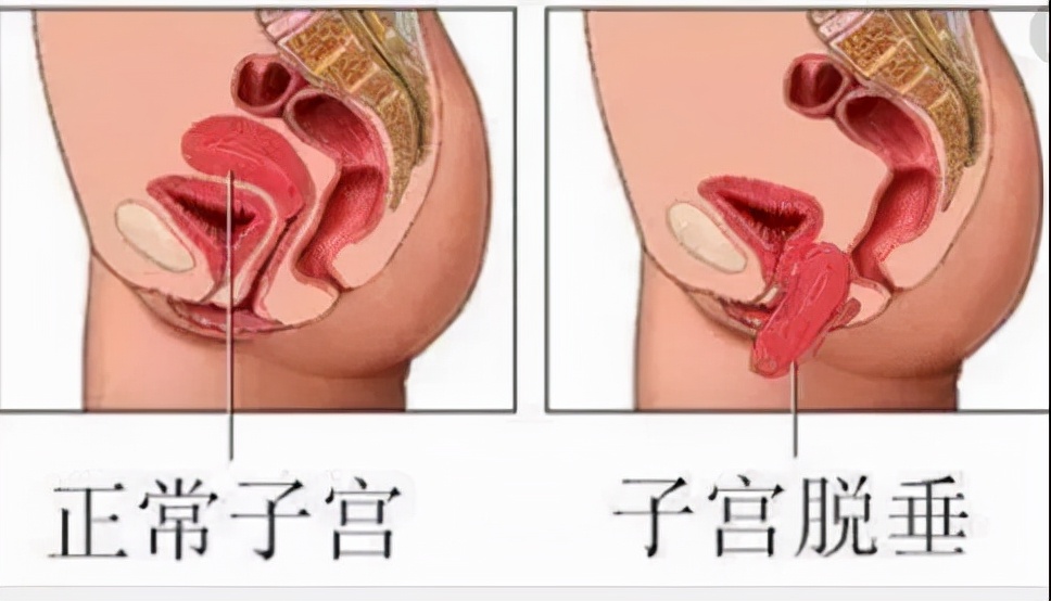 不要忽视产后恢复,新手妈妈产后该准备些什么