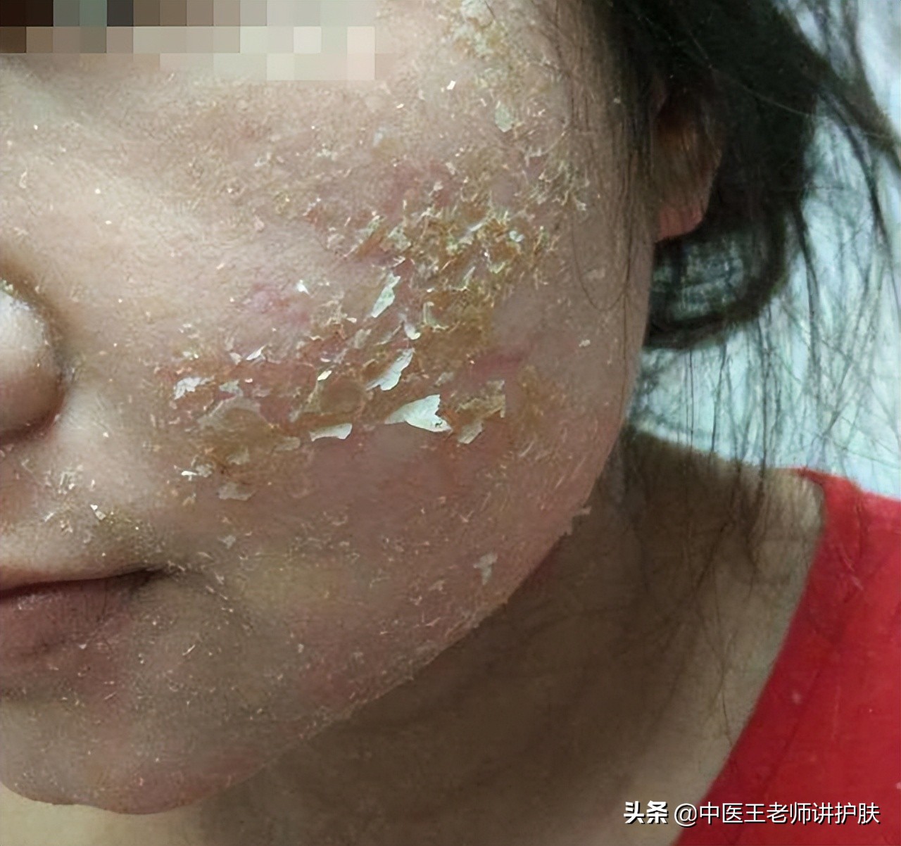 面部激素依赖性皮炎最佳治疗方法,面部激素依赖性皮炎能治好吗