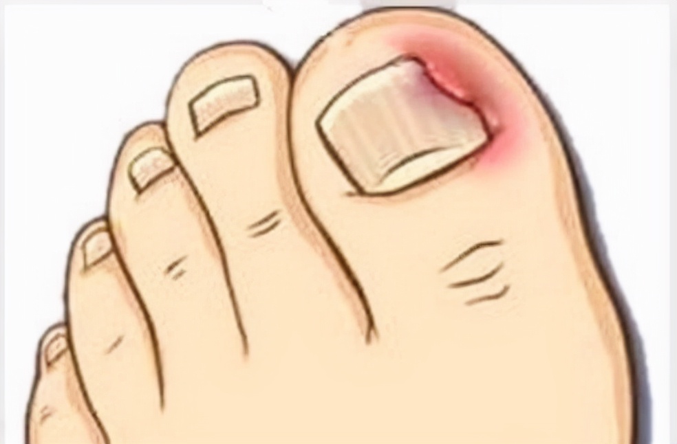 甲沟炎疼痛是指甲在长吗,甲沟炎红肿疼痛怎么快速消肿止疼