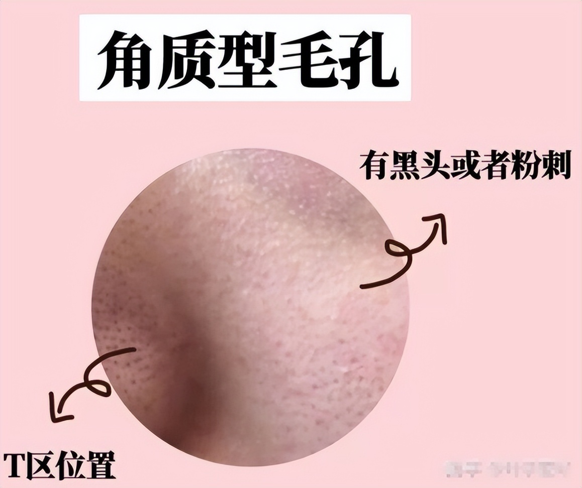 4种类型的毛孔粗大该怎么解决,怎样判断毛孔粗大的类型