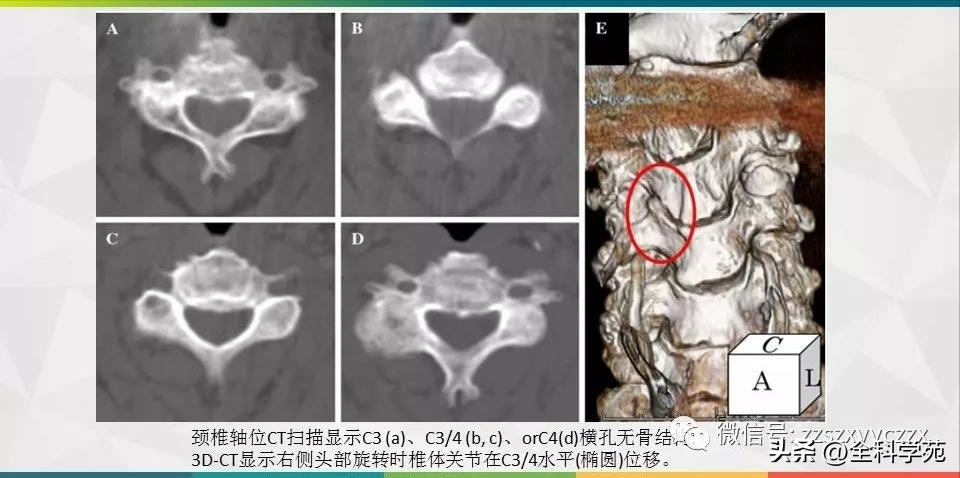 条件反射性眩晕,一种莫名的眩晕