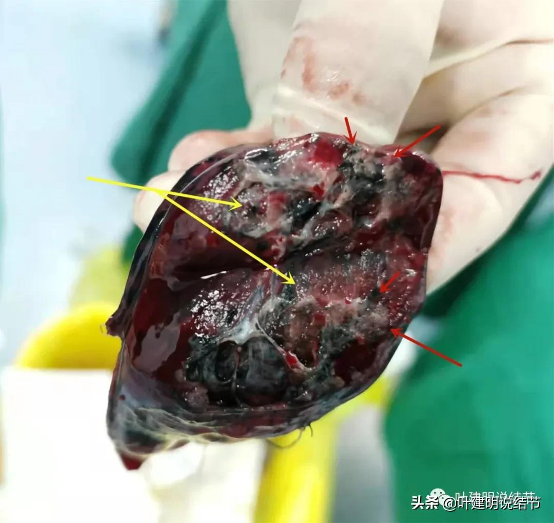 肺多发结节切除一个剩下的怎么办,无限纠结的肺小结节