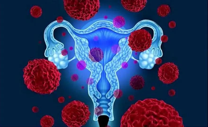 紧急提醒：有人中招查出宫颈癌？身上有一股臭味，不能大意