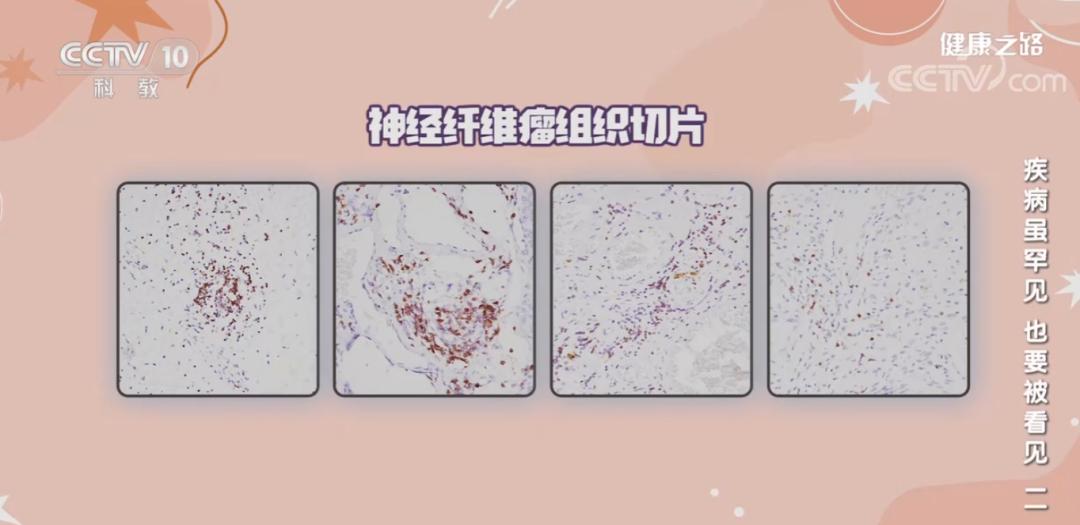 免疫细胞治疗肿瘤真实案例,免疫细胞对肿瘤是否有效好在哪里