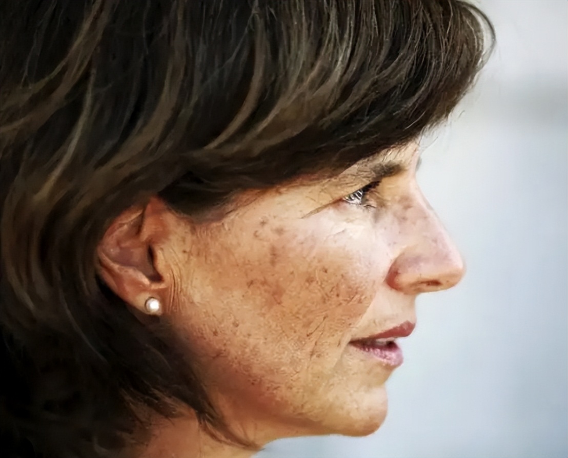 去除老年斑最有效的药膏,用什么药膏治疗老年斑最有效