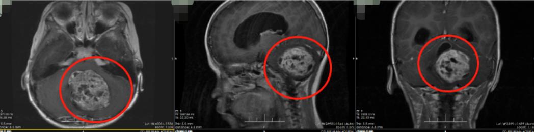 孩子恶心要警惕四种病,孩子脑肿瘤造成恶心呕吐