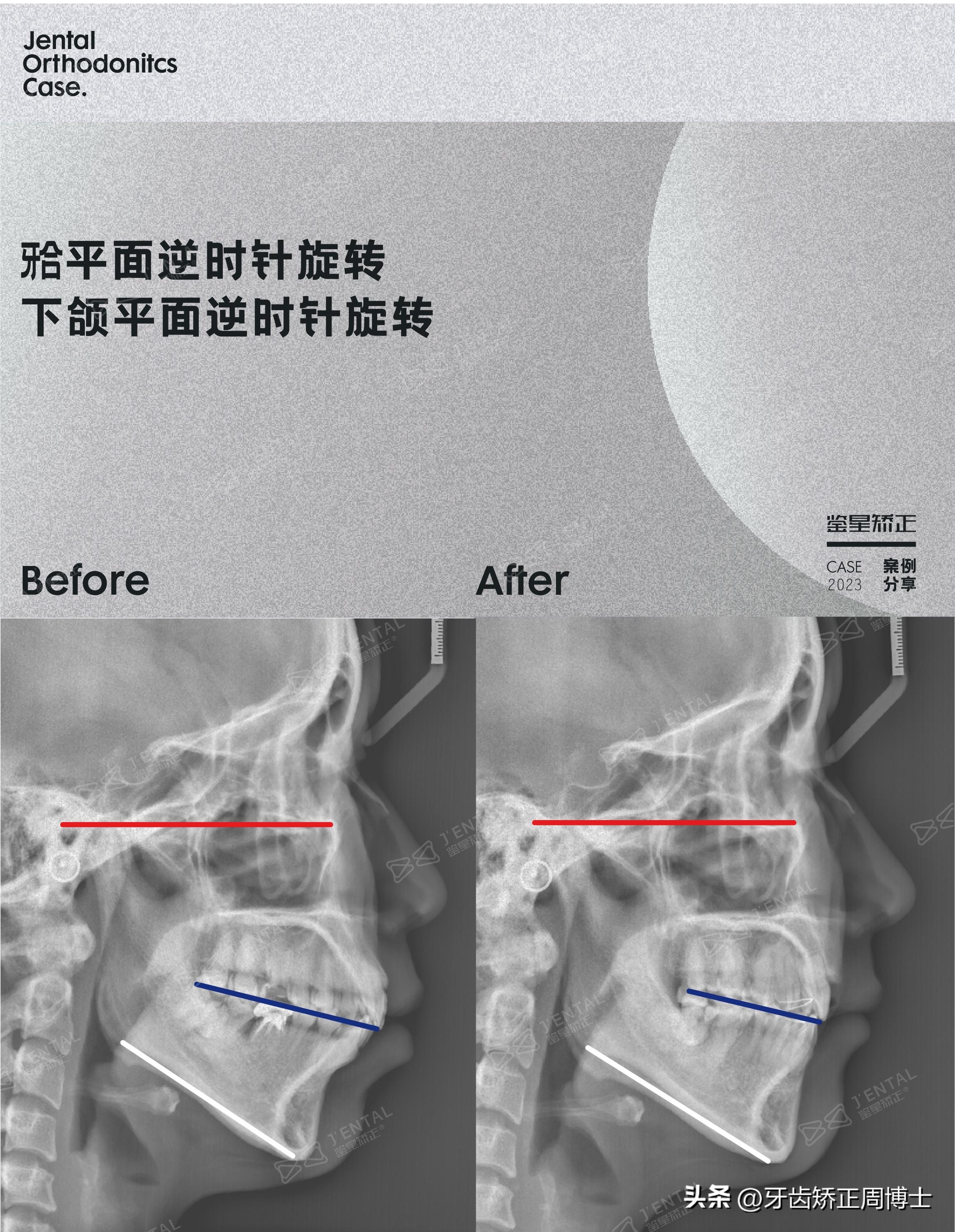 骨性龅牙怎么通过普通的矫正改善,骨钉如何解决骨性龅牙