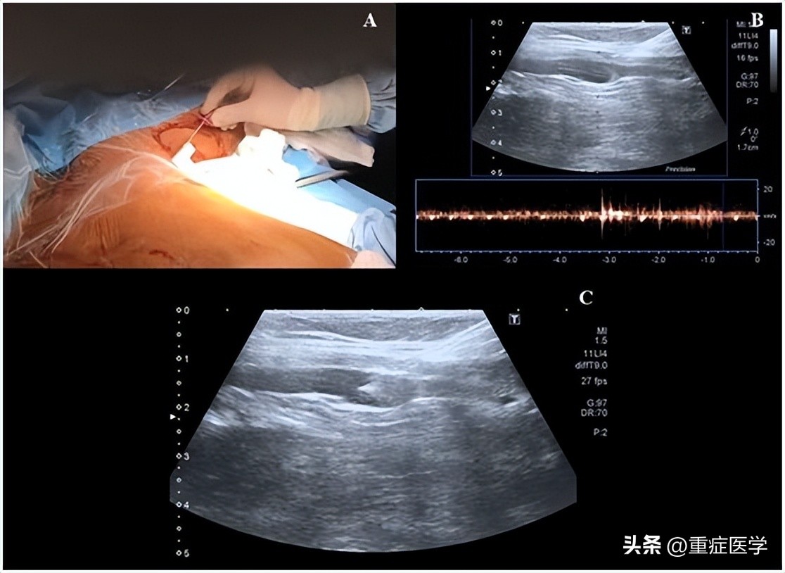 腋静脉穿刺技巧ppt,新生儿腋静脉穿刺技巧视频