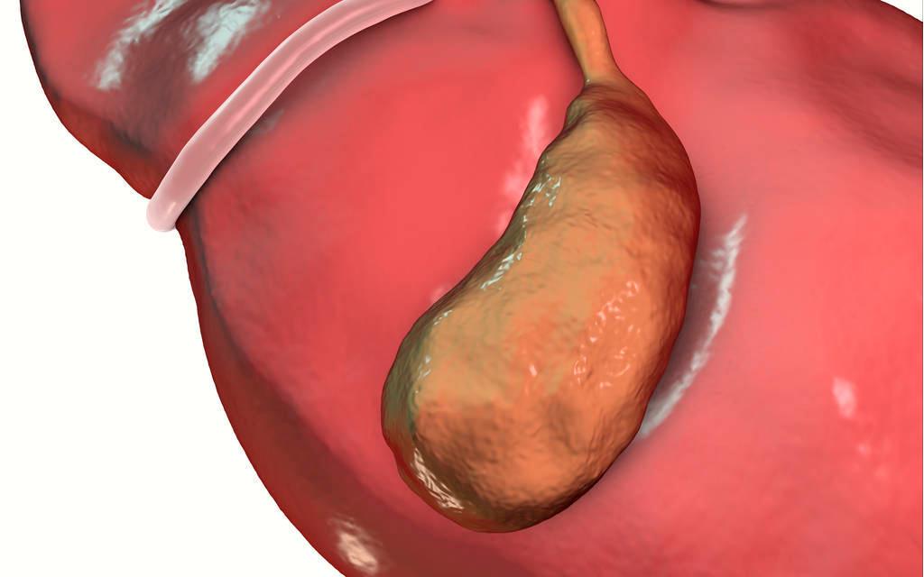70岁老人胆囊息肉能微创手术吗,78岁胆囊息肉要动手术吗
