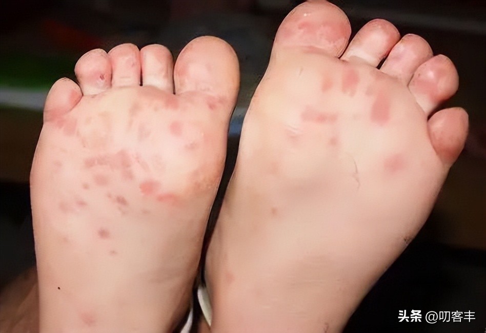 手足口病症状吃什么药好得快,手足口病在线咨询医生