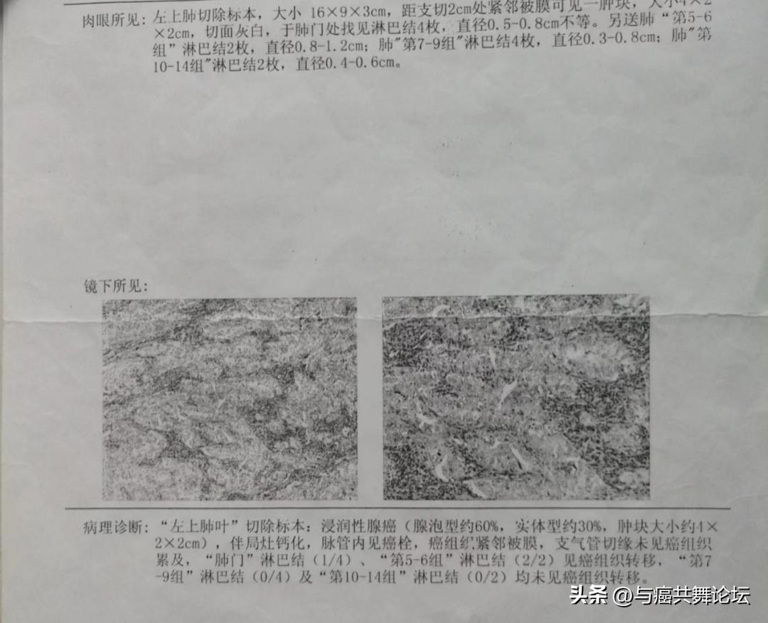 陪妻子抗癌，我发现中晚期肺癌活过5年也不难