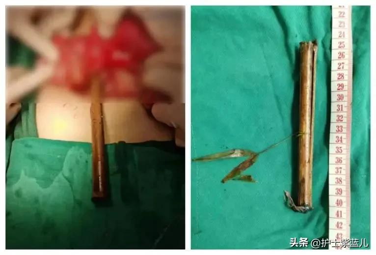 老人不慎从楼梯上重重摔下,老人意外从楼上摔下来