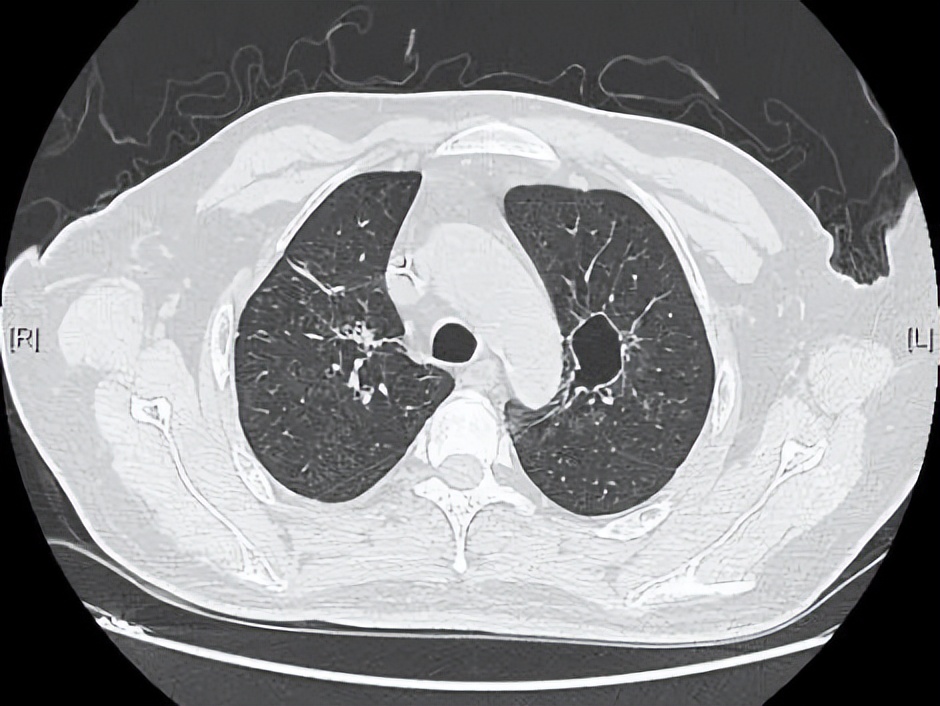 病死率和致死率,病死率20%
